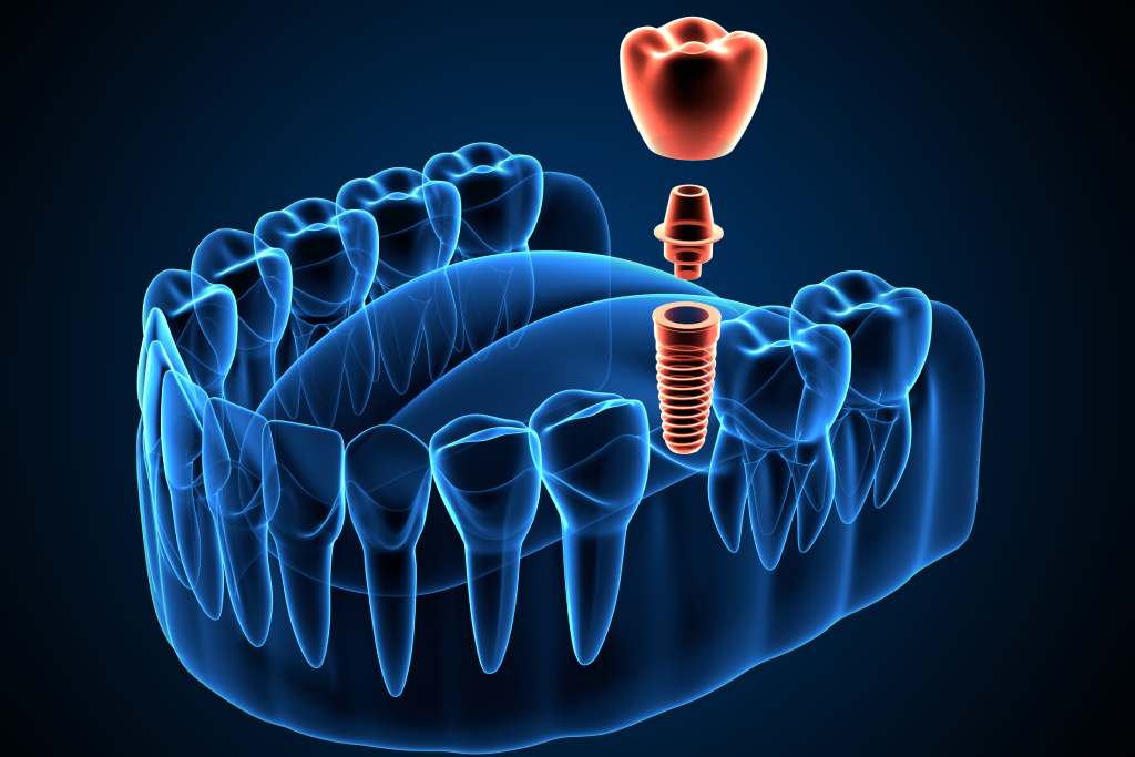 Dental Implants Fairmont MN