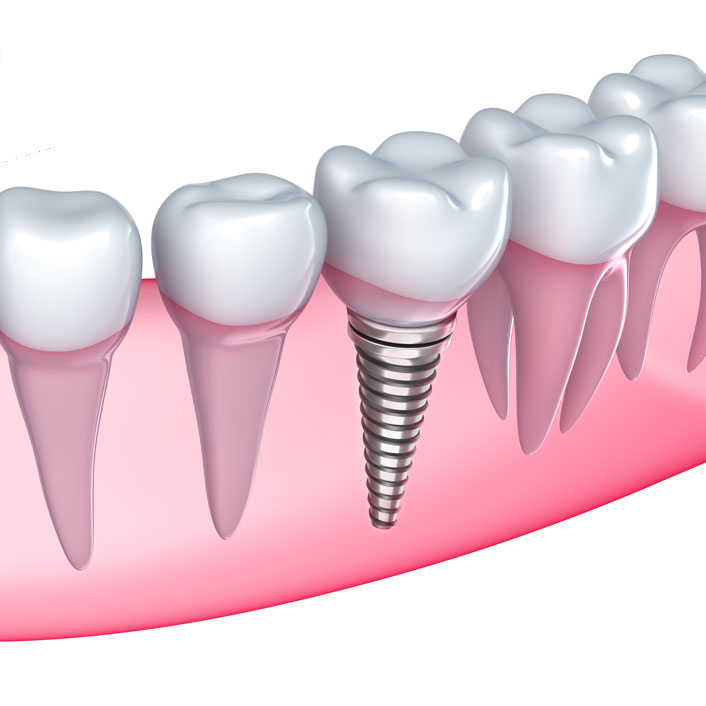 Dental Implants Fairmont MN